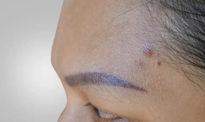 霧眉去除風險 霧眉去除風險