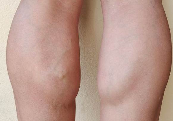 小腿粗壯改善 小腿粗壯改善