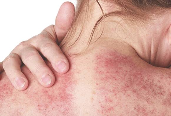 刮痧運動注意事項