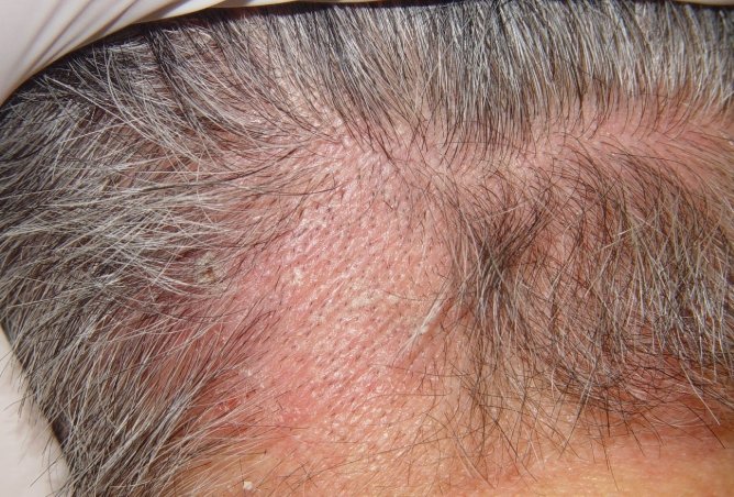 脂漏性皮膚炎 多久會好