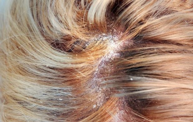 脂漏性皮膚炎 多久會好