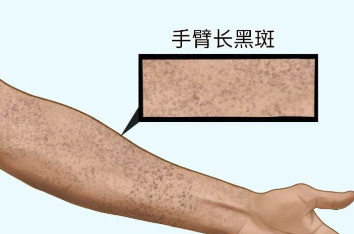 手臂黑斑原因