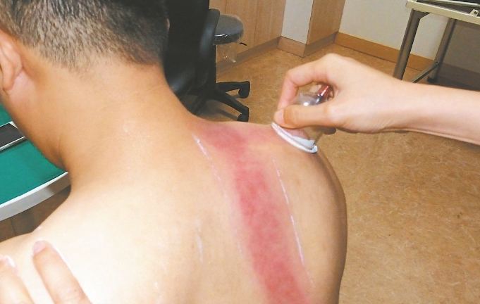 刮痧後飲酒注意事項