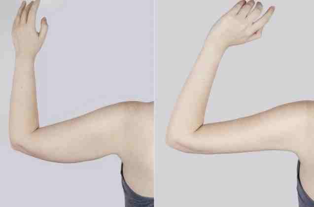 瘦手臂最快方法 瘦手臂最快方法