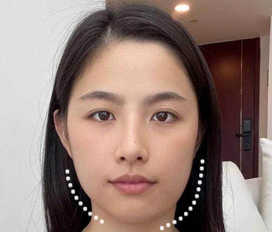 臉部不對稱矯正