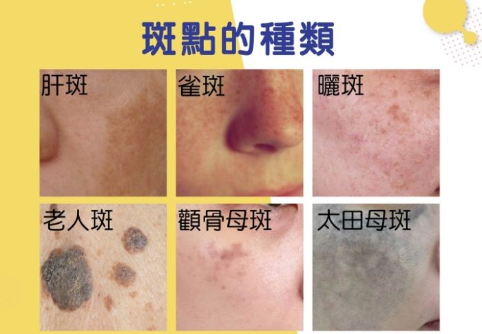 虎口色素沉着治療