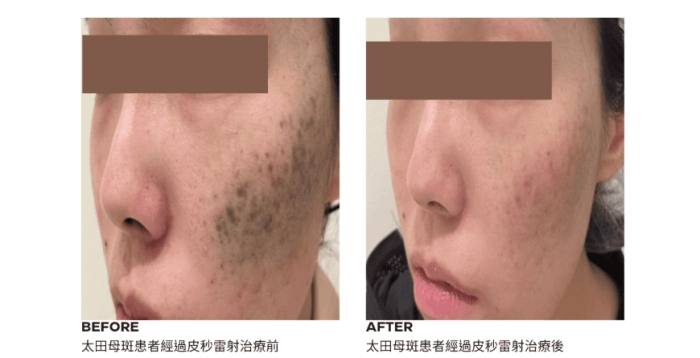 黑斑變大治療