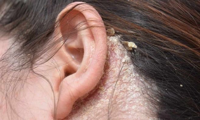 頭皮脂漏性皮膚炎 治療時間