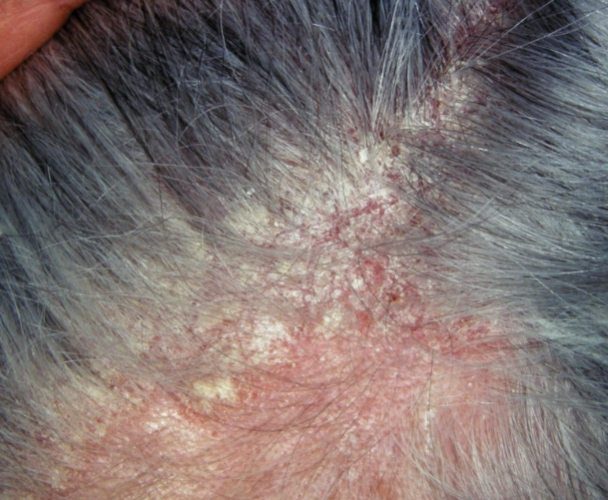 頭皮脂漏性皮炎 恢復期