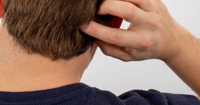 頭皮癢怎麼辦 頭皮癢怎麼辦