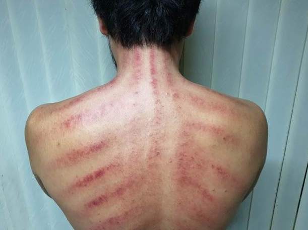 刮痧後運動時機