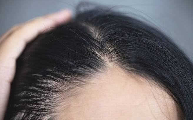 头顶头发稀疏