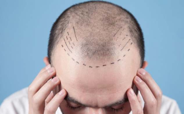 头顶头发稀疏