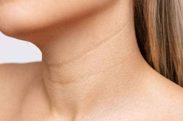 頸紋消除方法 頸紋消除方法