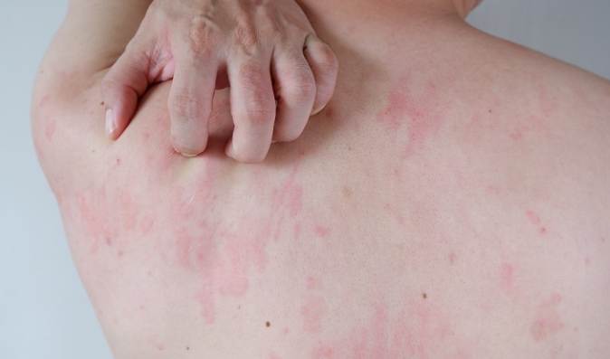 蕁麻疹症狀原因