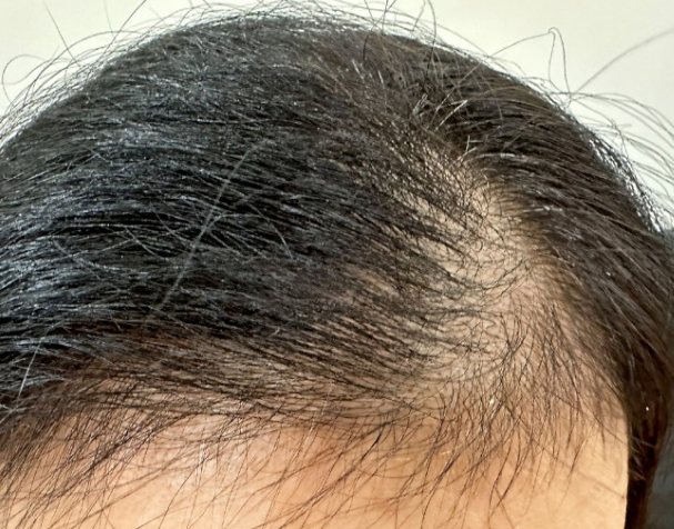 女性頭頂稀疏