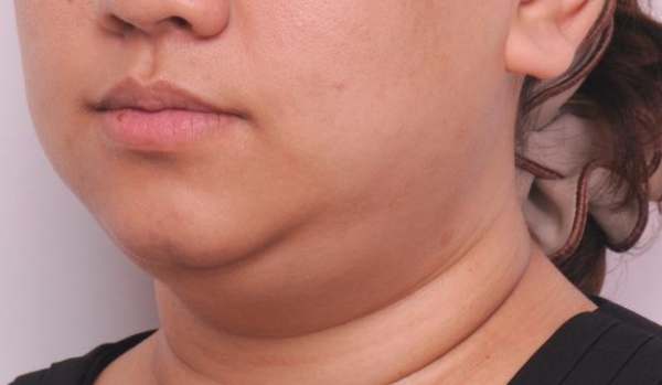 下顎線模糊成因 下顎線模糊成因