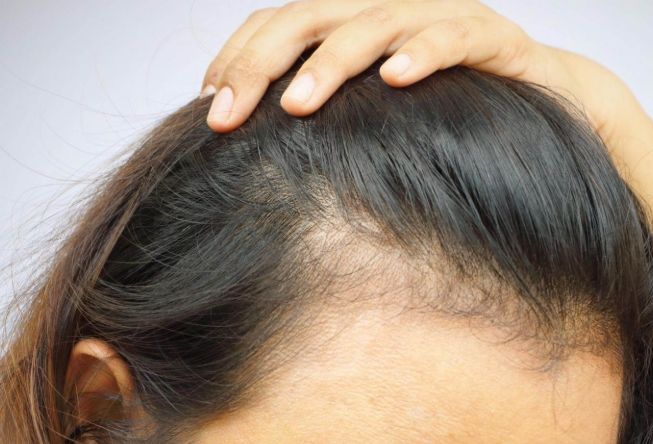頭頂稀疏原因