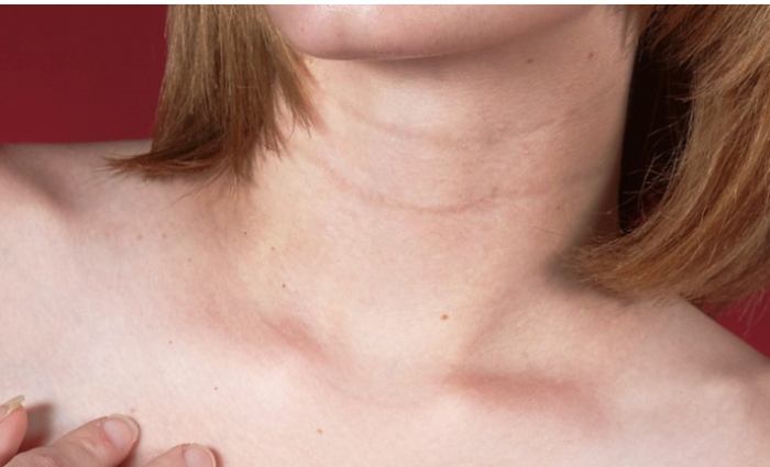 頸紋消除方法 頸紋消除方法