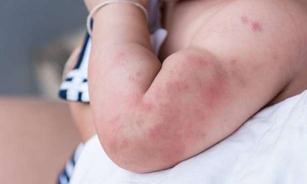 丘疹性蕁麻疹治療 丘疹性蕁麻疹治療