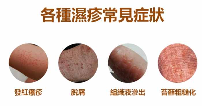 丘疹性蕁麻疹圖片 丘疹性蕁麻疹圖片