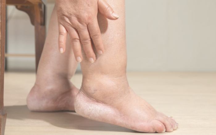 喝酒腳水腫治療