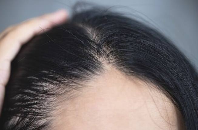 女性掉髮原因