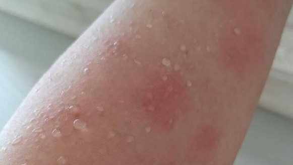 丘疹性蕁麻疹症狀原因