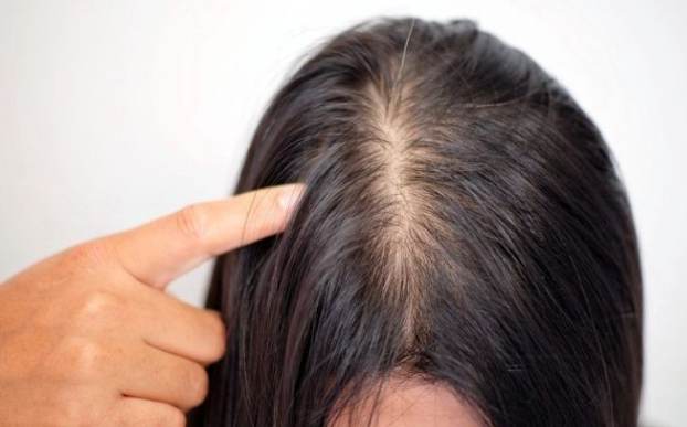 女性掉髮原因