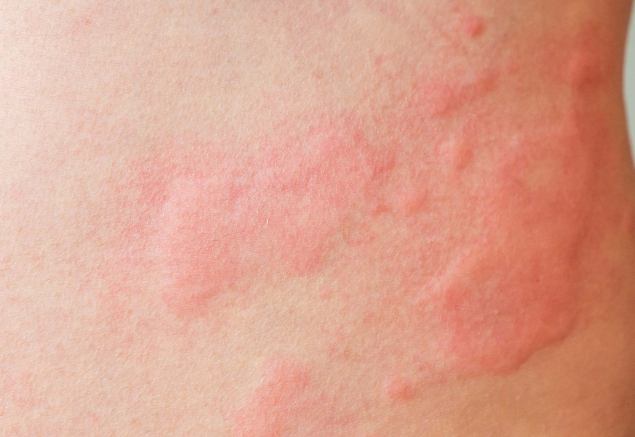 戒菸皮膚過敏 戒菸皮膚過敏