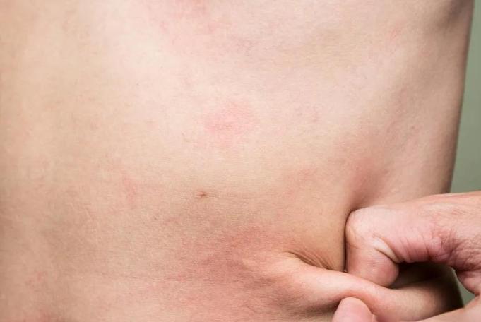 丘疹性蕁麻疹成因