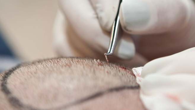 頭髮再生方法 頭髮再生方法