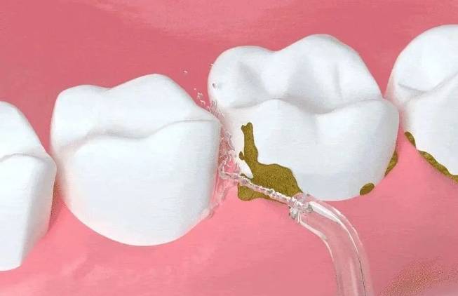 沖牙機 替代 牙線