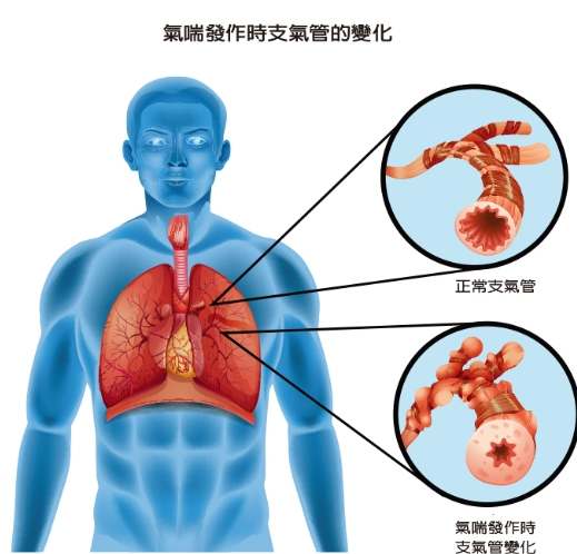 氣管收縮症狀