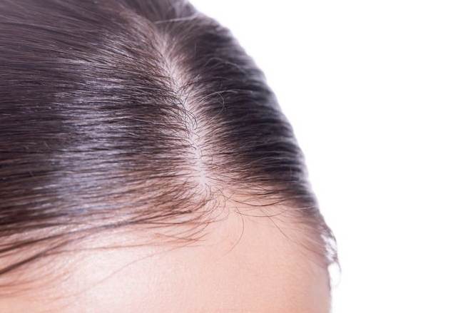 頭髮稀疏改善