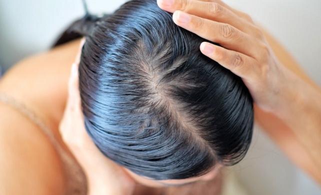 掉髮治療 掉髮治療