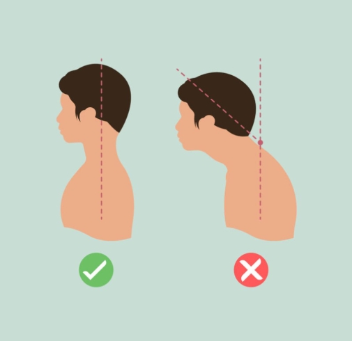烏龜頸改善 烏龜頸改善
