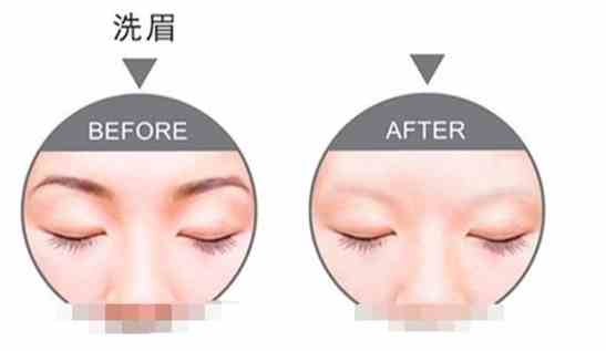 雷射洗眉