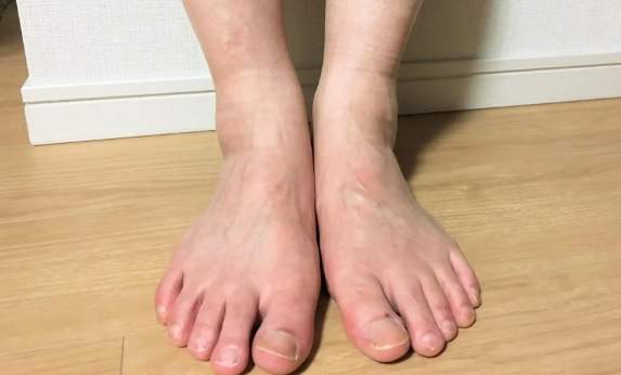 喝酒腳水腫原因