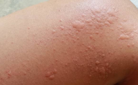 戒菸副作用 戒菸副作用