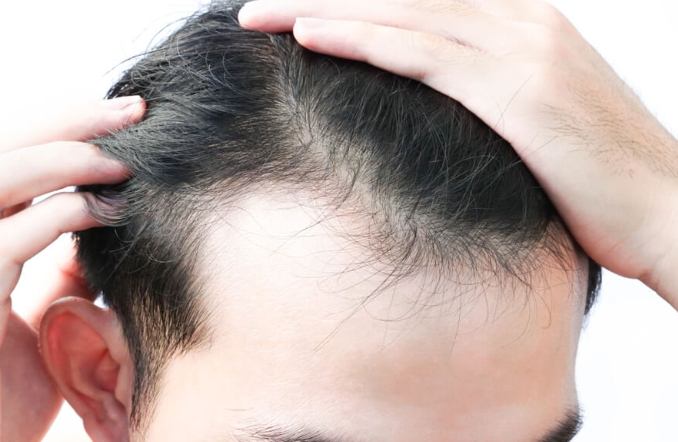 男性頭頂稀疏