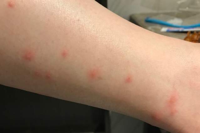 丘疹性蕁麻疹成因