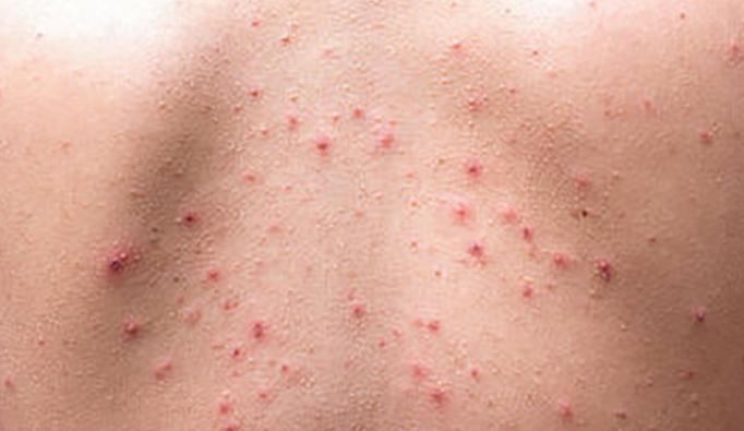 丘疹性蕁麻疹症狀原因