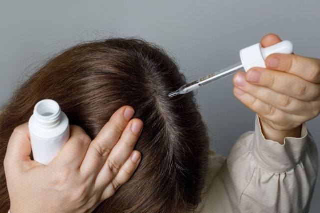掉髮治療方法