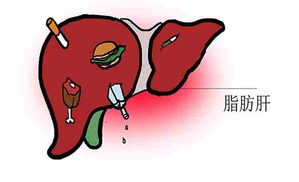 脂肪肝運動治療 脂肪肝運動治療