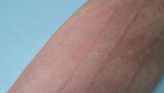 戒菸皮膚過敏 戒菸皮膚過敏