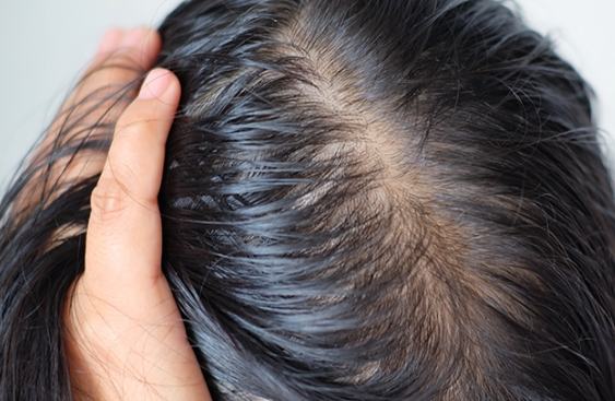 頭髮變細原因