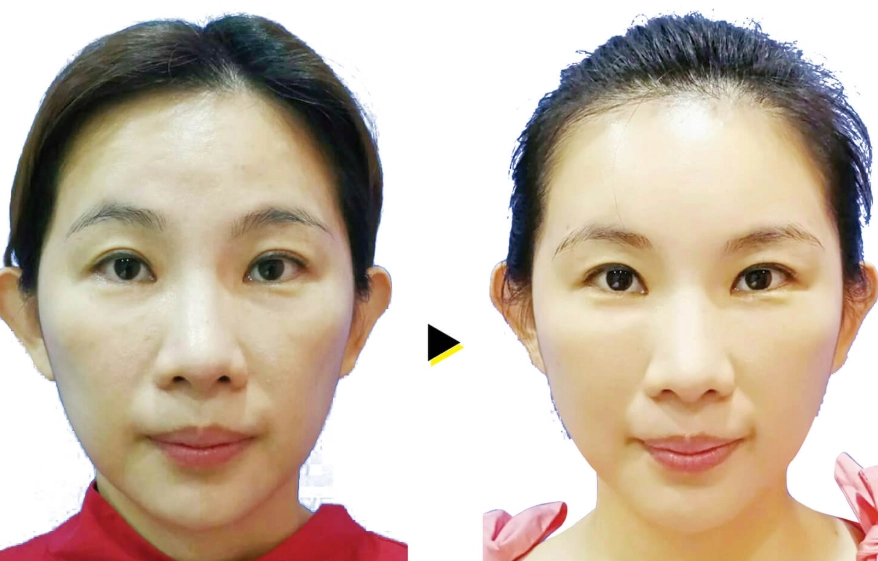 臉部脂肪過多原因