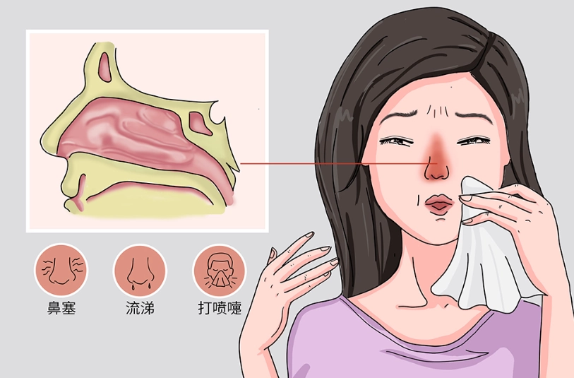 鼻塞怎麼辦
