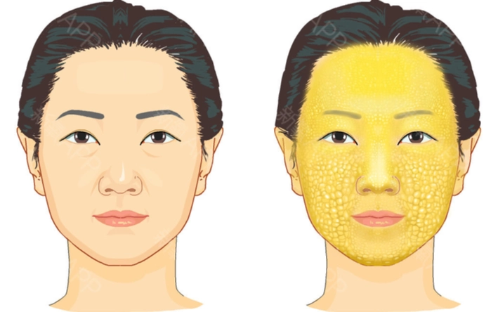 臉部脂肪過多原因